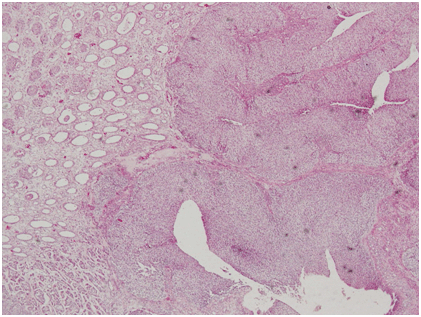 urotherlial carcinoma